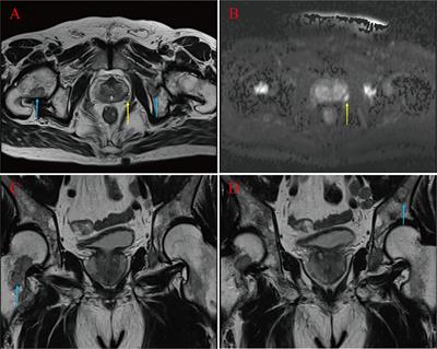 Advanced prostate cancer diagnosed by bone metastasis biopsy immediately after initial negative prostate biopsy: a case report and literature review